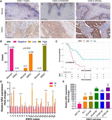 Development and Validation of a Ferroptosis-Related Gene Signature and Nomogram for Predicting the Prognosis of Esophageal Squamous Cell Carcinoma